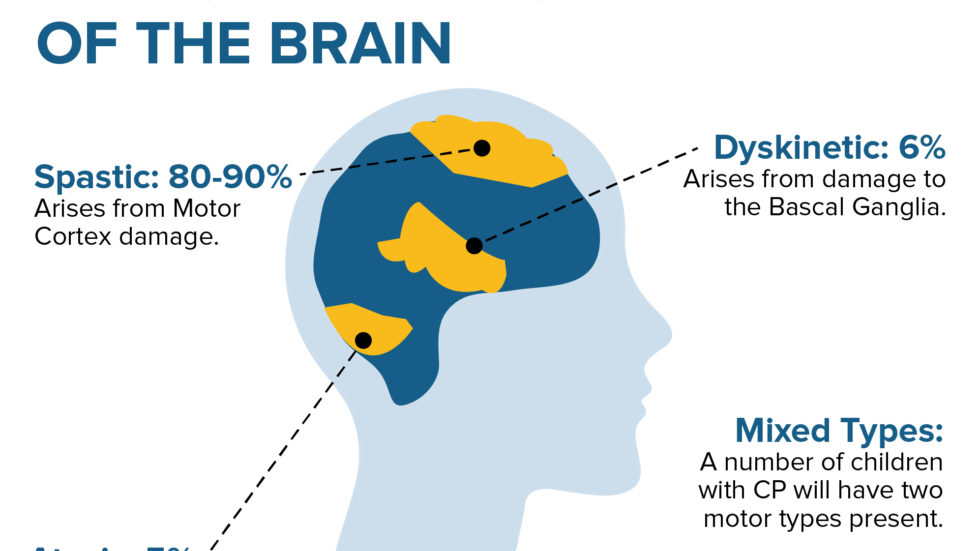 All About Cerebral Palsy 